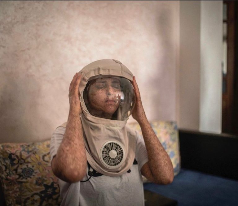 مغرب تايمز - غياب دعم الدولة.. أطفال القمر بين حلكة الظلام وأمل في سطوع الشمس