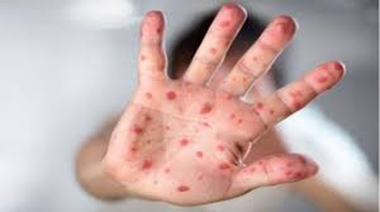 مغرب تايمز - فرنسا تُسجل 51 إصابة جديدة بجدري القرود