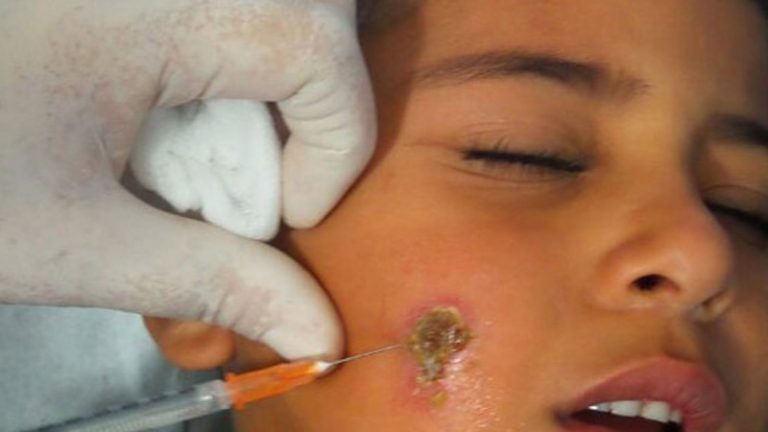 مغرب تايمز - مرض "اللشمانيا" يستنفرُ المصالح الصحية بالمغرب